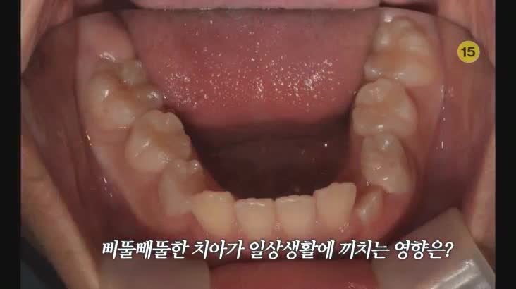 (01/20 방영) 메디컬 24시 닥터스 2부 – 삐뚤삐뚤한 치아 고민에서 가지런한 자신감 찾기