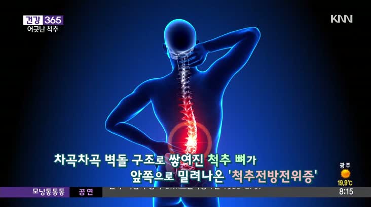 [건강 365]척추의 어긋난 만남 척추전방전위증