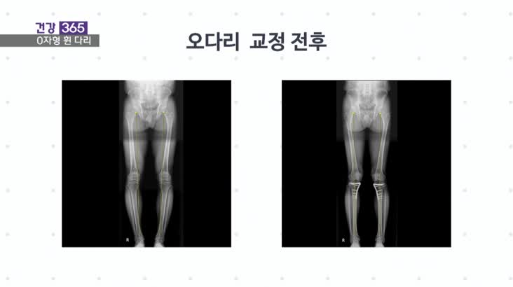 [건강365]-나이 들수록 휘는 ‘O자형 다리’ 치료는?