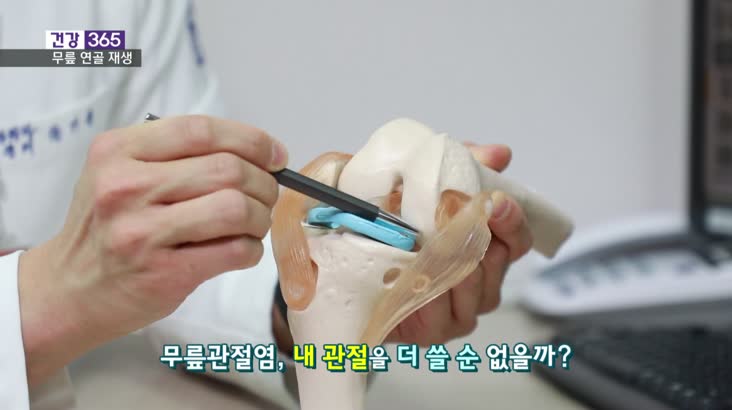 [건강365]-인공관절 수술 전 ‘연골 재생?’