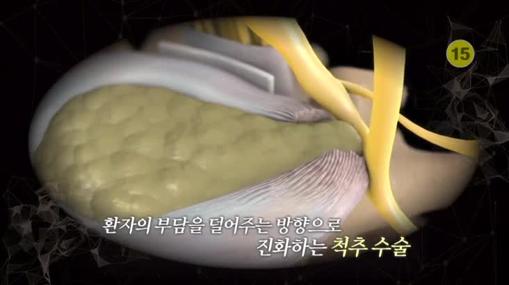 (01/03 방영) 메디컬 24시 닥터 – 척추 수술, 내시경 시대 열었다!