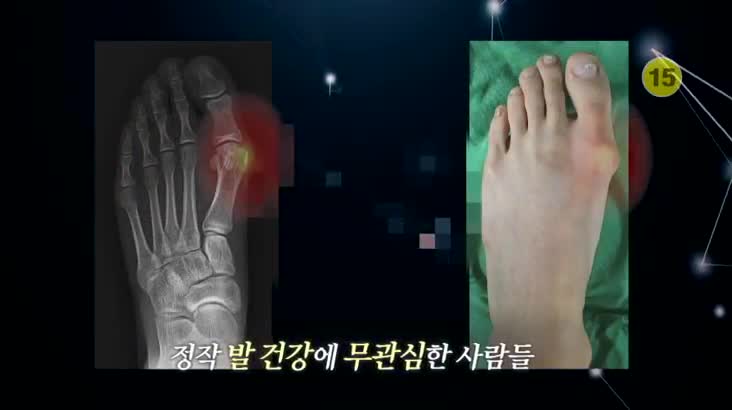 (05/23 방영) 메디컬 24시 닥터스 – 발가락이 점점 휜다면? 무지외반증 치료